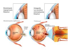 Παγκόσμια Εβδομάδα Γλαυκώματος: Ενημέρωση για τον “σιωπηλό κλέφτη της όρασης”