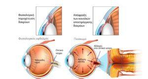Παγκόσμια Εβδομάδα Γλαυκώματος: Ενημέρωση για τον “σιωπηλό κλέφτη της όρασης”