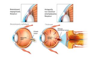 Παγκόσμια Εβδομάδα Γλαυκώματος: Ενημέρωση για τον “σιωπηλό κλέφτη της όρασης”